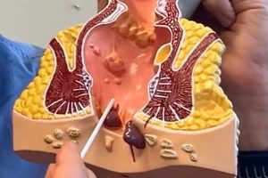 Model of Anal Cytology Exam by Dr. Schlussel