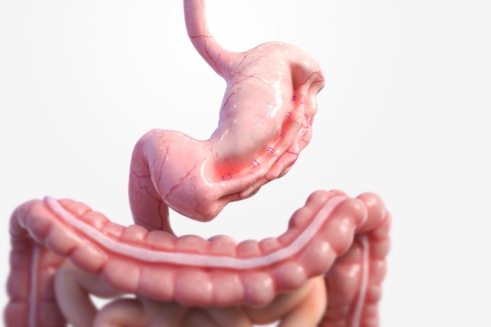 >Comparing Endoscopic and Surgical Sleeve