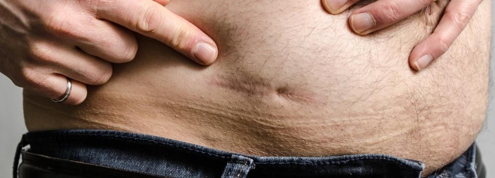 Man posting to a small scar on his abdomen after bariatric surgery 
