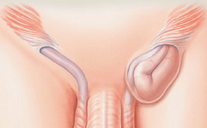 Department Of Surgery Inguinal Hernia