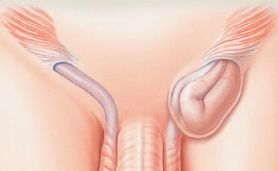 >What is a hernia?