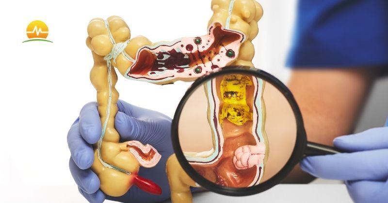 Doctor in blue scrubs magnifies colorectal health issues on model colon showing conditions that can be diagnosed during a colonoscopy. MASJax logo at top left.