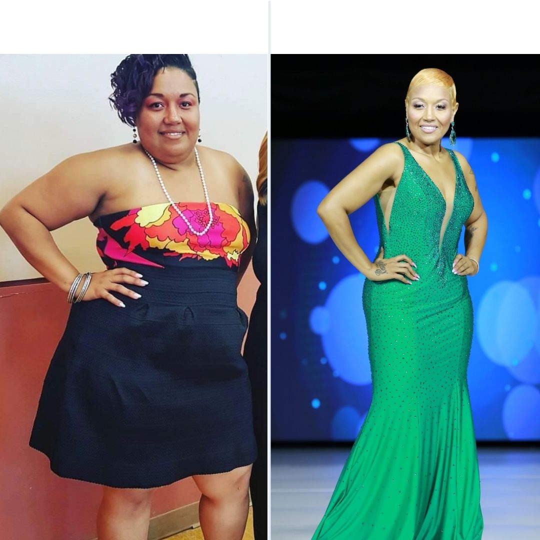 >Antoinette - Gastric Sleeve