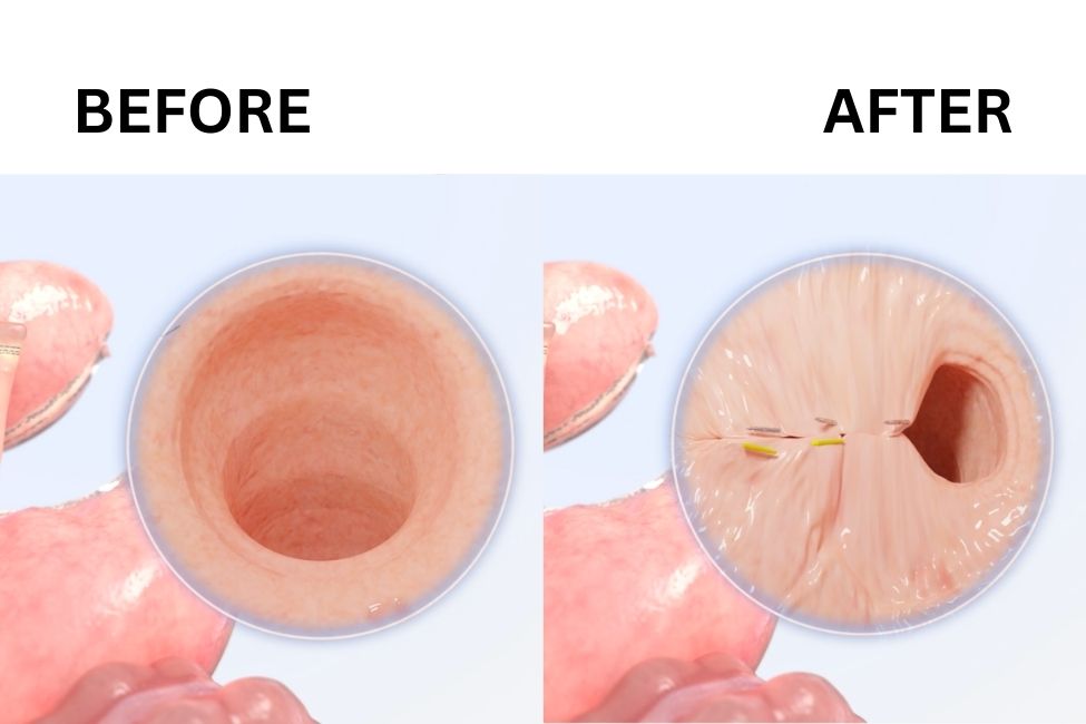 >What are the Results of the TORe Procedure?