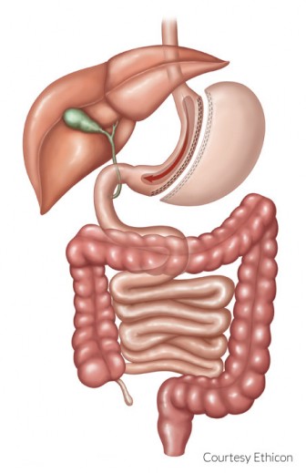 Gastric Sleeve / Vertical Sleeve Gastrectomy Surgery